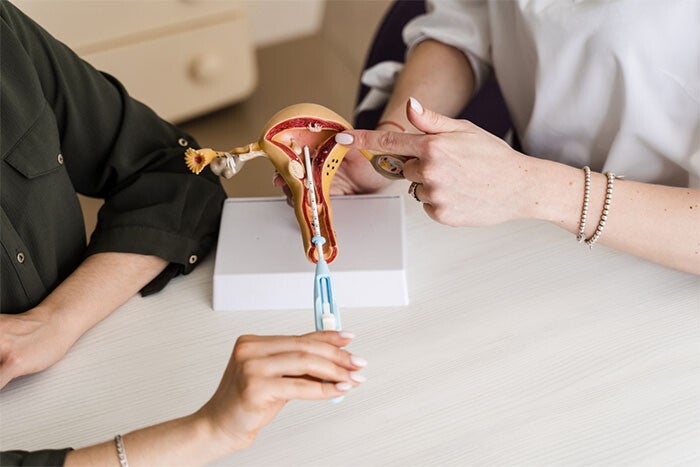 A photo of an intrauterine device being inserted into a uterus model during a gynecology consultation about birth control methods