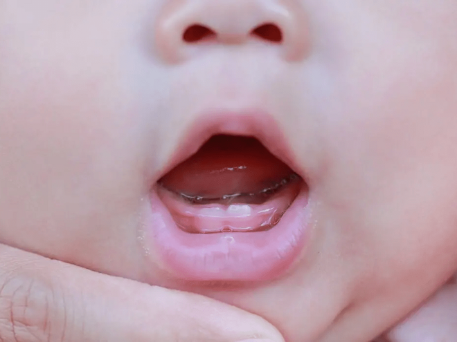 Should I Be Worried About My Baby’s Late Teething?